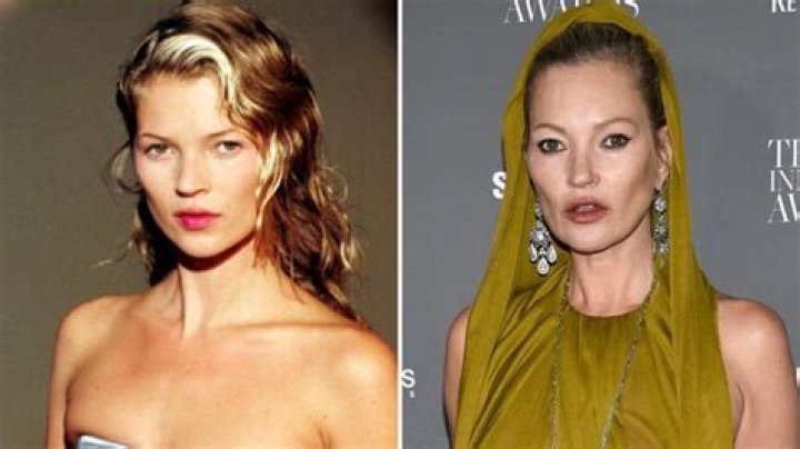 Did Kate Moss Ever Get Plastic Surgery? Photos of the Model’s Transformation Over the Years