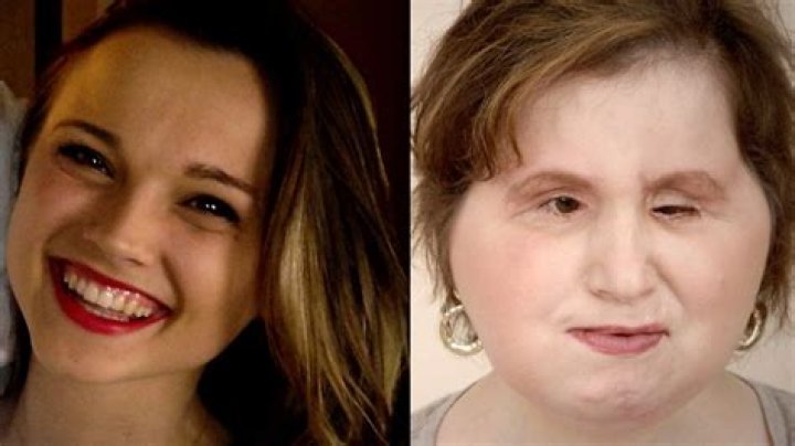 Face Transplant Gives Cameron Underwood New Lease On Life