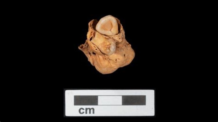 Tumor With Teeth Found In The Body Of A 3,000-Year-Old Egyptian Woman